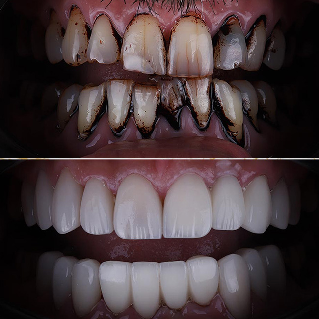 Hollywood Smile: Before and After