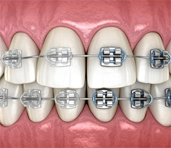 Dental Braces