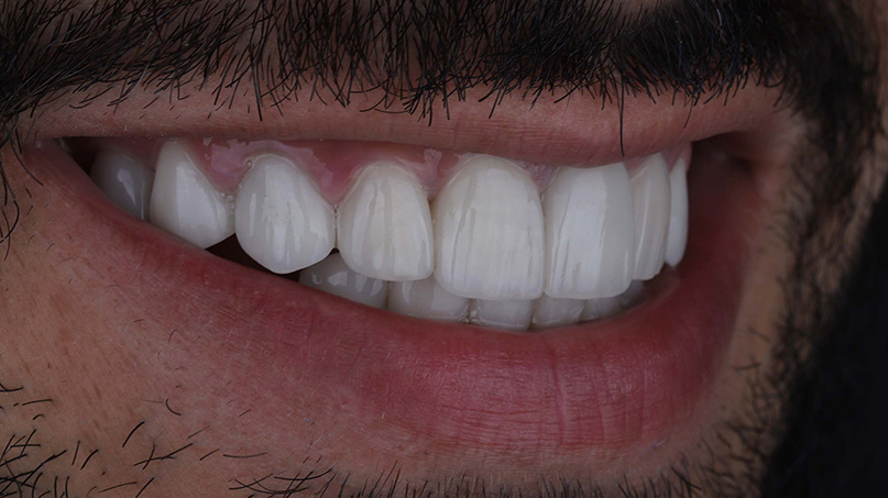 Dental Veneers after