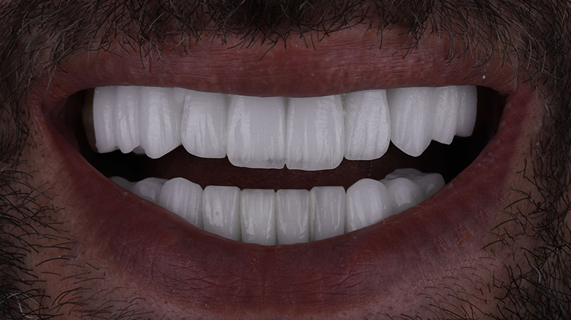 Dental Veneers after