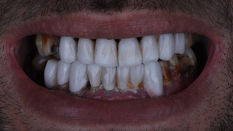 Dental Veneers slider before