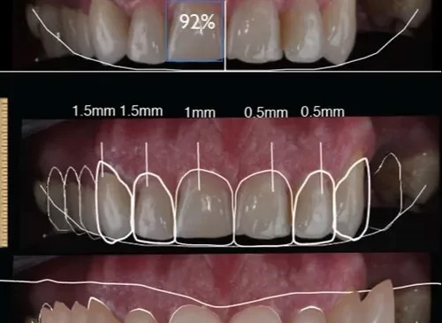 Digital Smile Design (DSD)