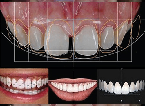 Digital Smile Design (DSD)