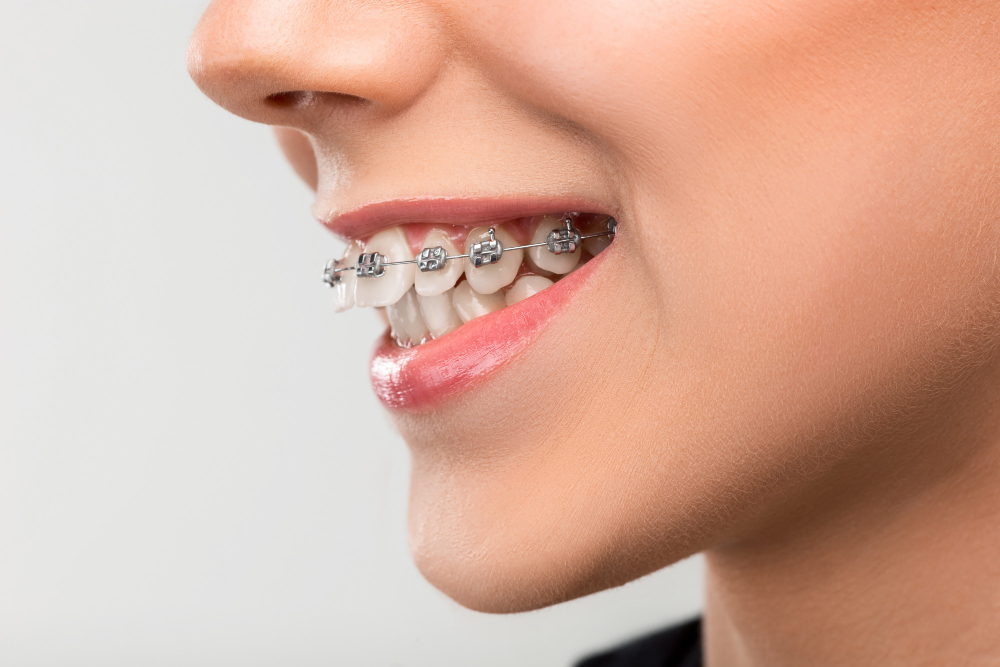 Dental braces Dubai