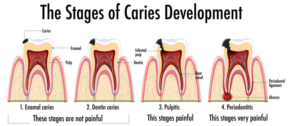 Infographic of human in the stages of caries development