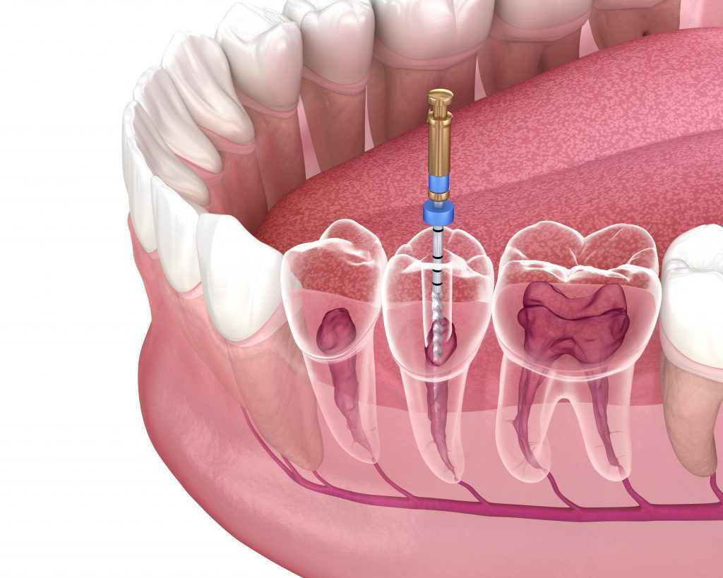 Root Canal procedure