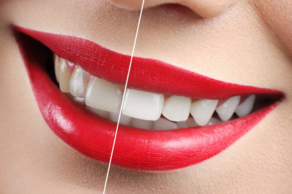 Cosmetic-dentist-teeth-whitening