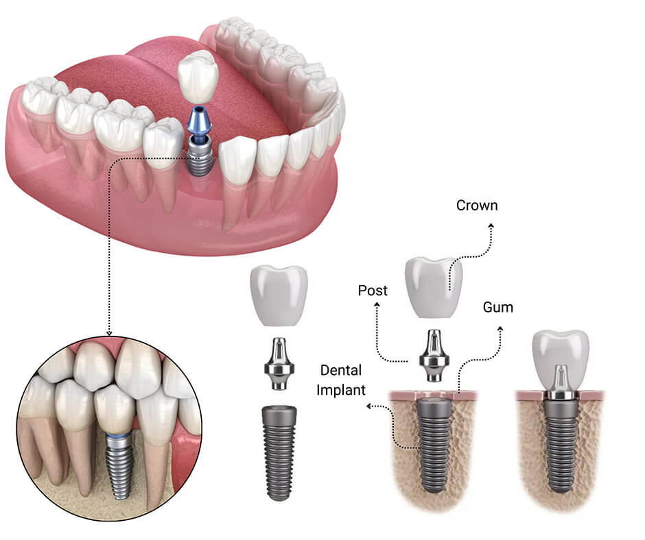 Dental Implant procedure