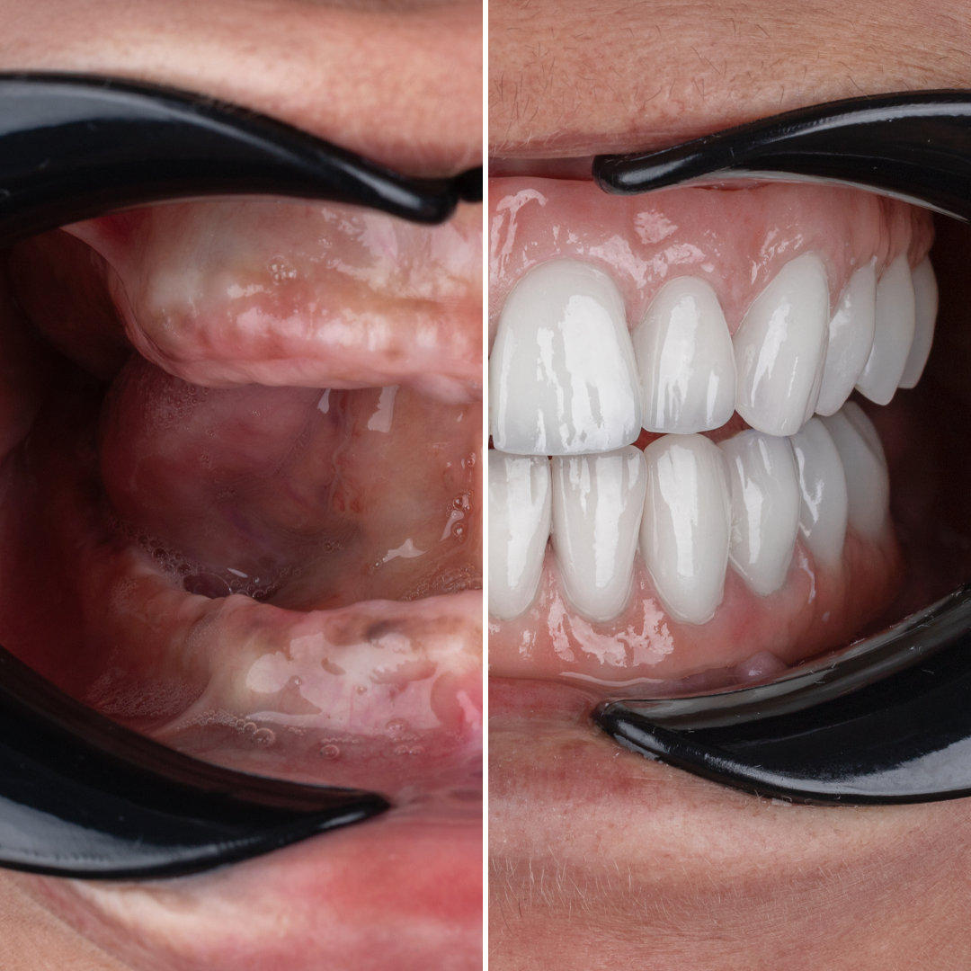 Dental Implant before and after