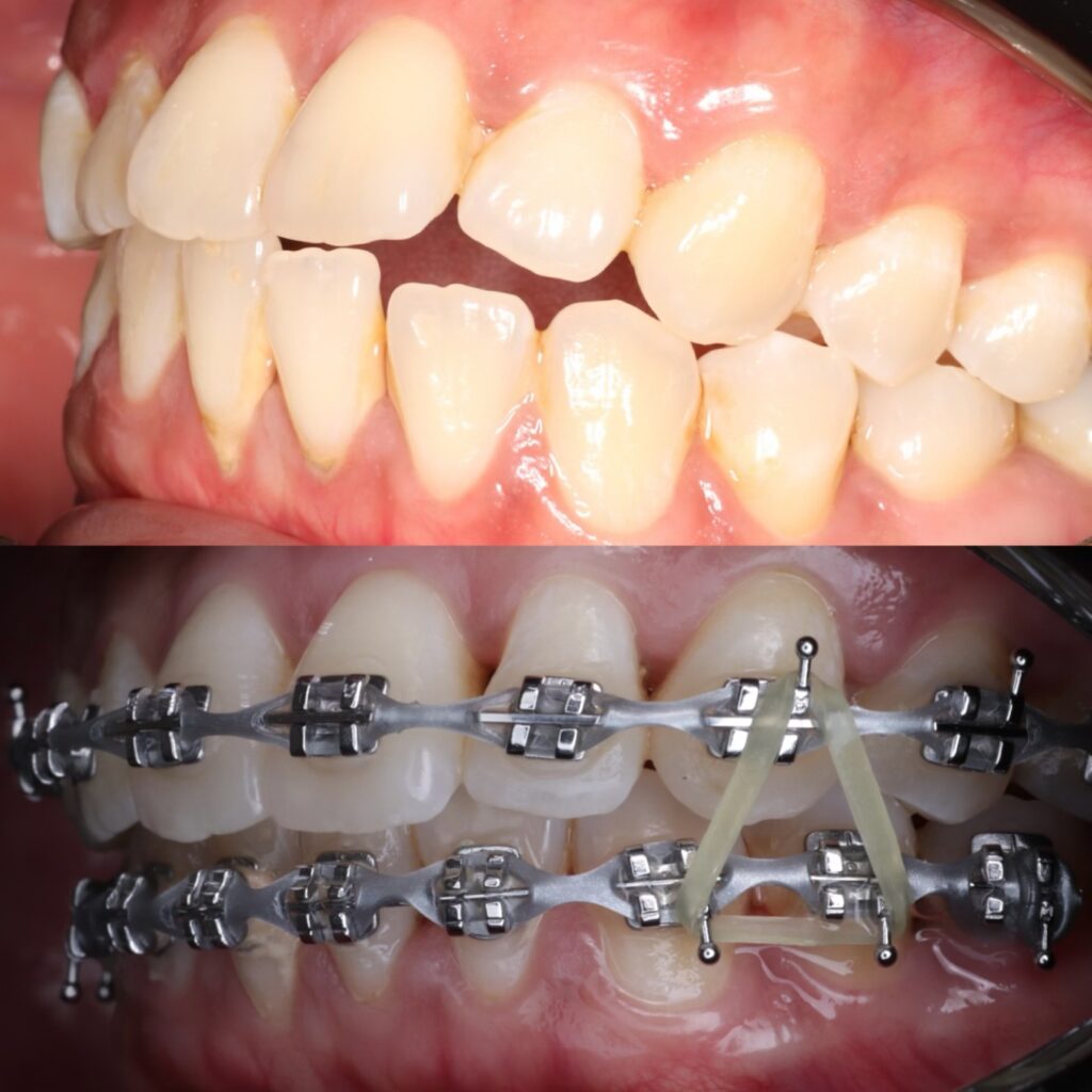 Dental Braces close view