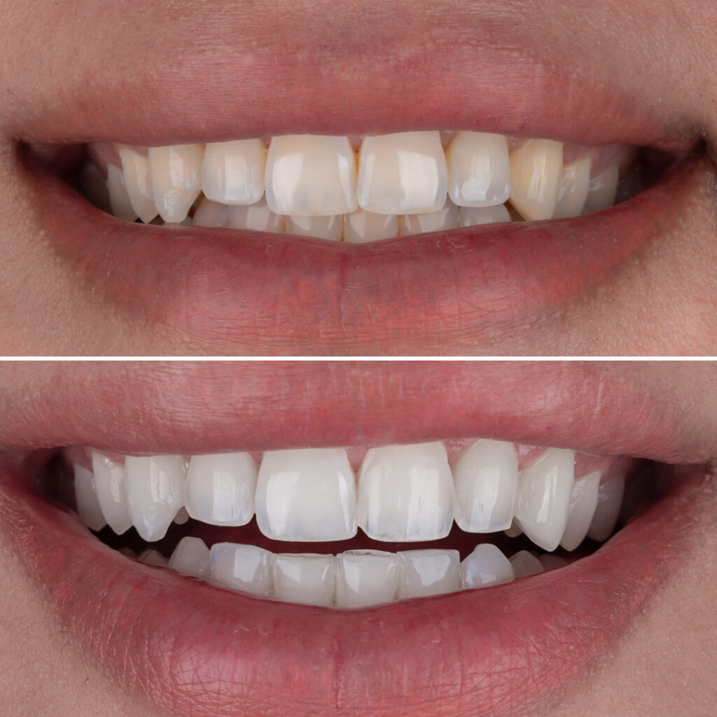 Teeth Whitening before and after