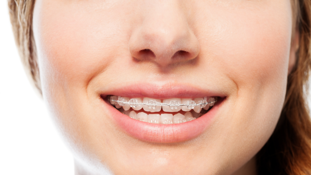 Pros-and-Cons-of-Ceramic-Braces