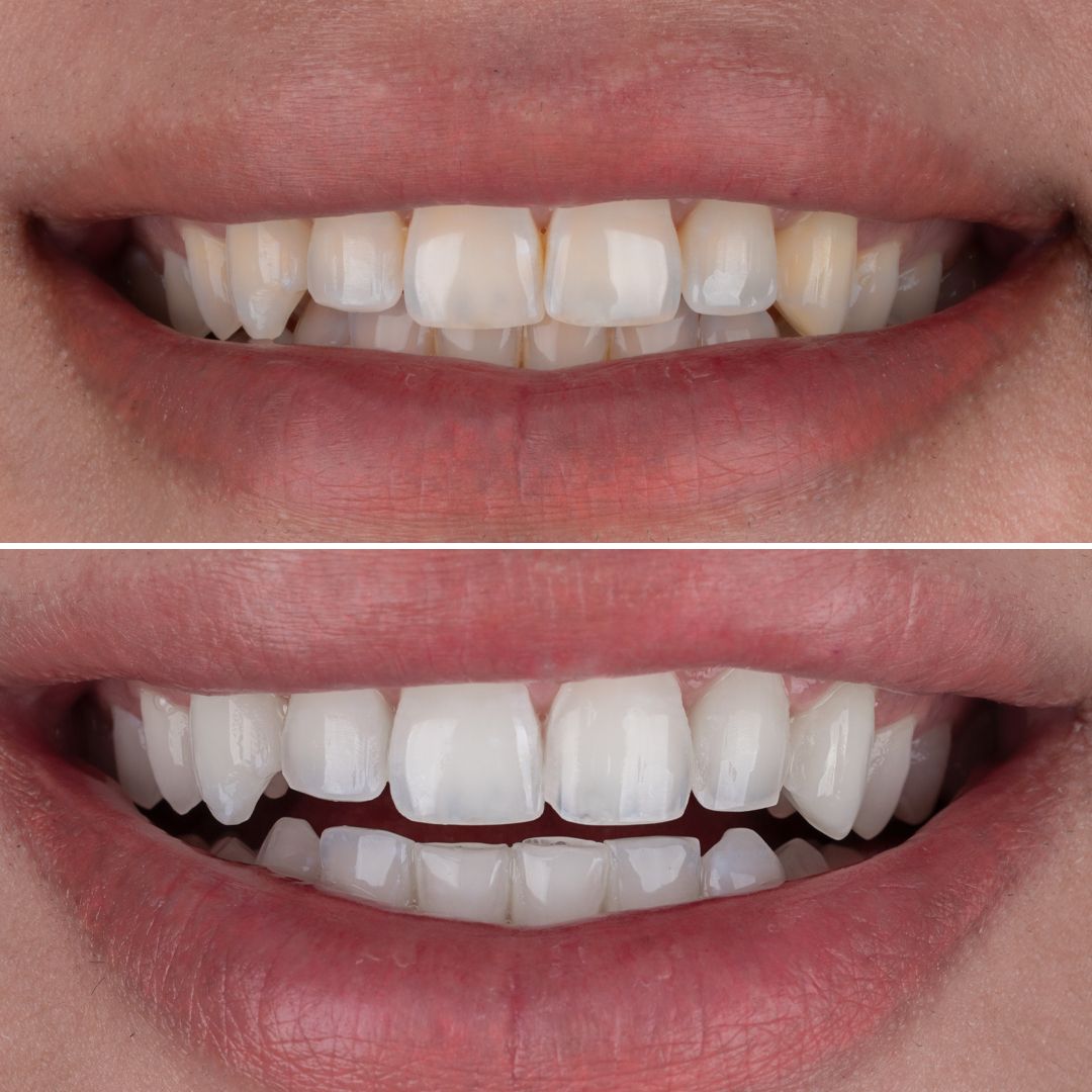 before and after Teeth Whitening