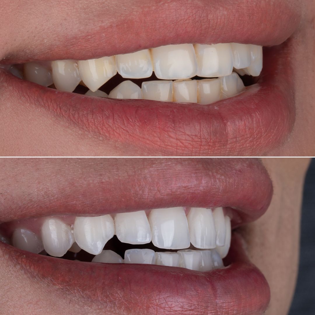 before and after Teeth Whitening