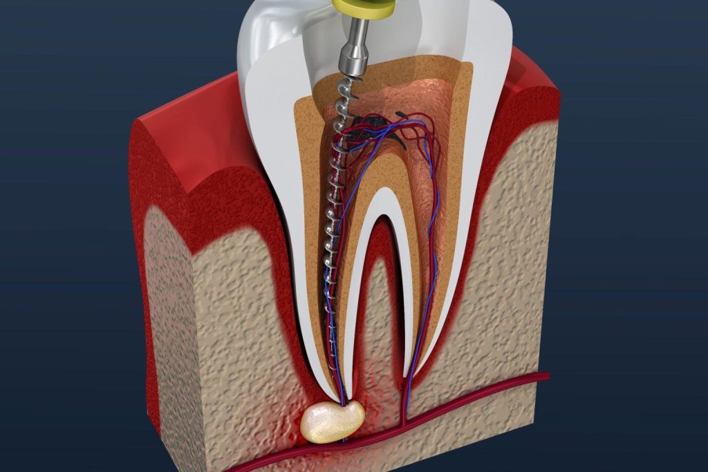 Root Canal image