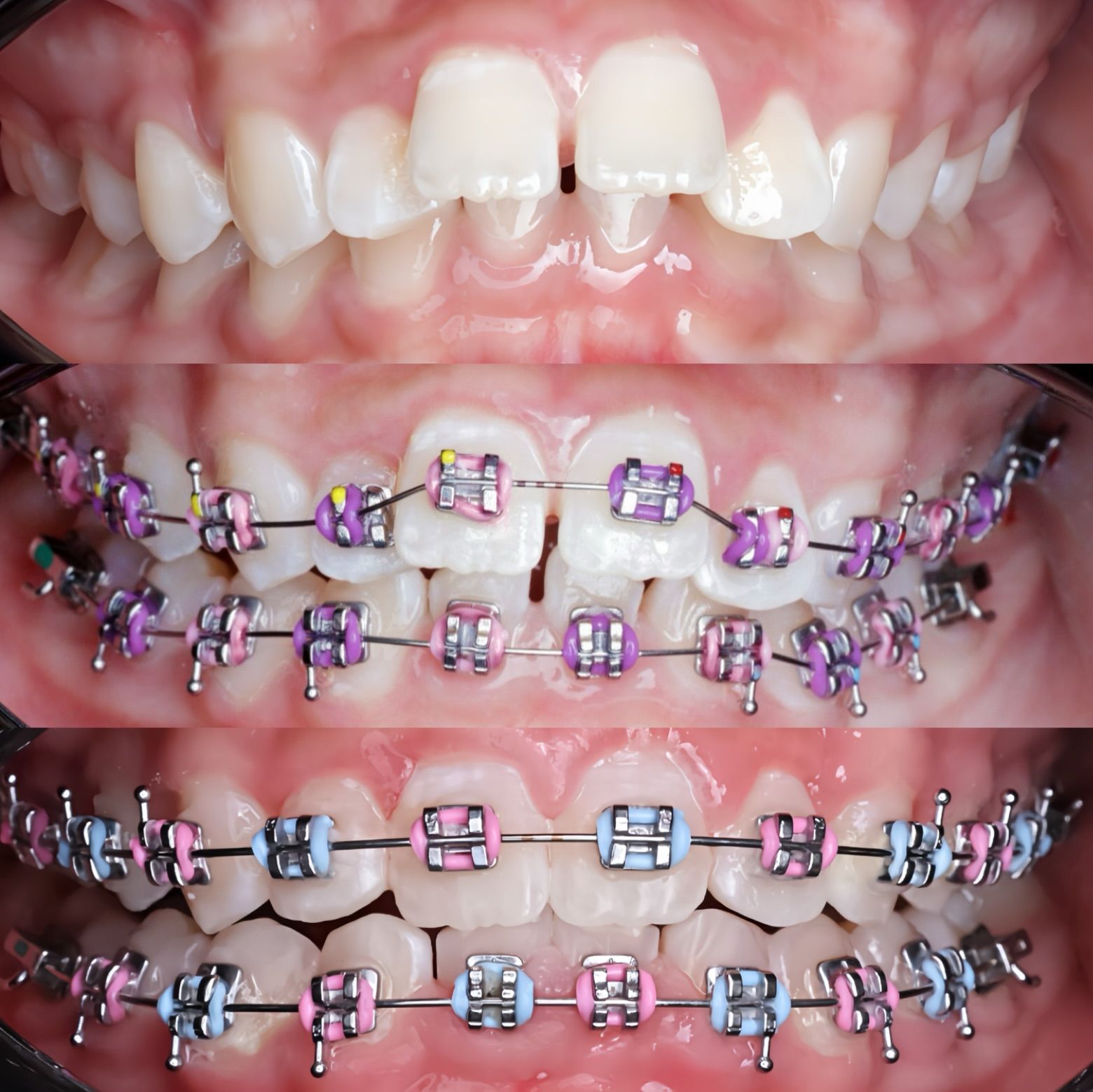 before and after Dental Braces