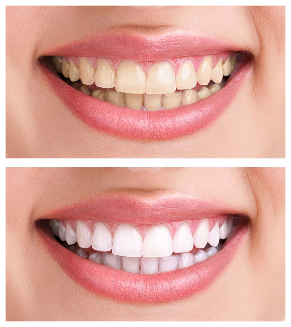 teeth-whitening