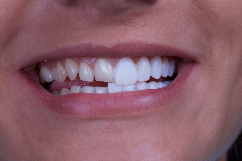 veneers-scaled Hollywood Smile